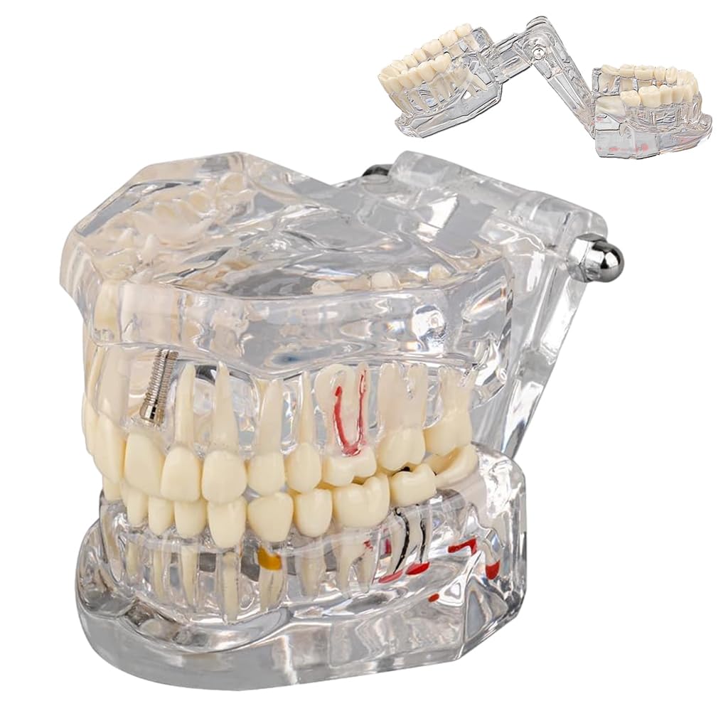 Serplex Transparent Dental Model 1: 1 Adults Pathological Dental Model with Detachable Teeth Educational Tool for Dentists, Hygienists, Students Serplex Transparent Dental Model 1: 1 Adults Pathological Dental Model with Detachable Teeth Educational Tool for Dentists, Hygienists, Students